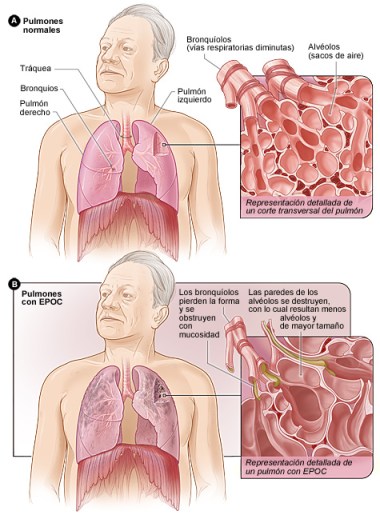 copd_sp_2012 (1)