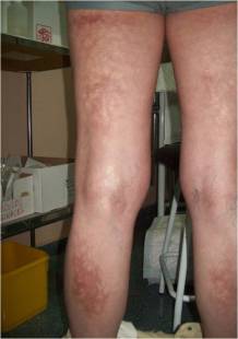 VIII Jornada de la Unidad Docente de MFyC de Ciudad Real. Desafío de casos clínicos 10x10. Solución a los caso