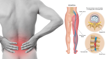 sciatica.png